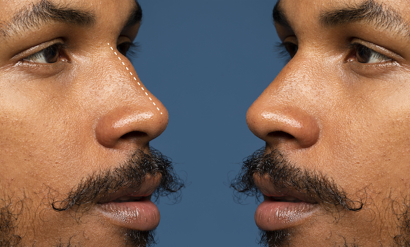 Bild man före och efter näsoperation